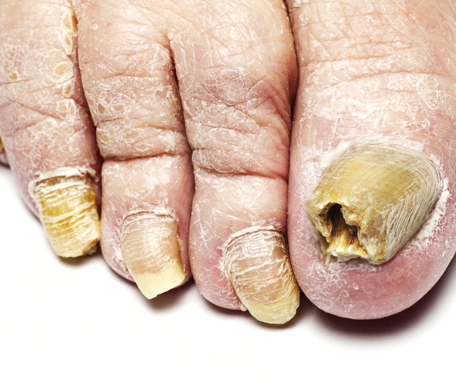 𝗠𝘆𝗰𝗼𝘀𝗲 𝗱𝗲𝘀 𝗼𝗻𝗴𝗹𝗲𝘀 (𝗼𝗻𝘆𝗰𝗵𝗼𝗺𝘆𝗰𝗼𝘀𝗲) - BioLeven.com